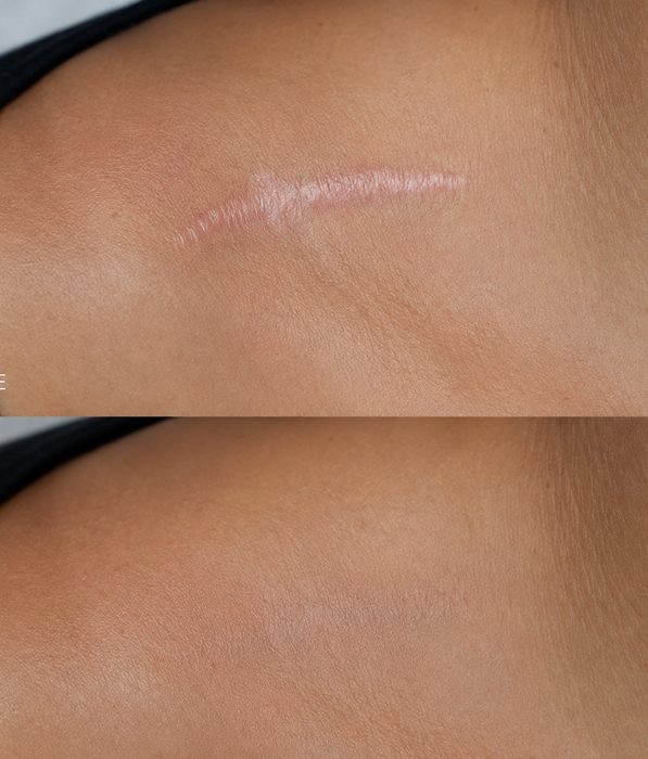 Example scar camouflage photo